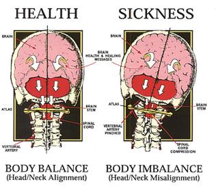 The effects of spinal misalignment can result in illness