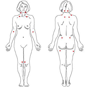 Tender Points Associated With Fibromyalgia